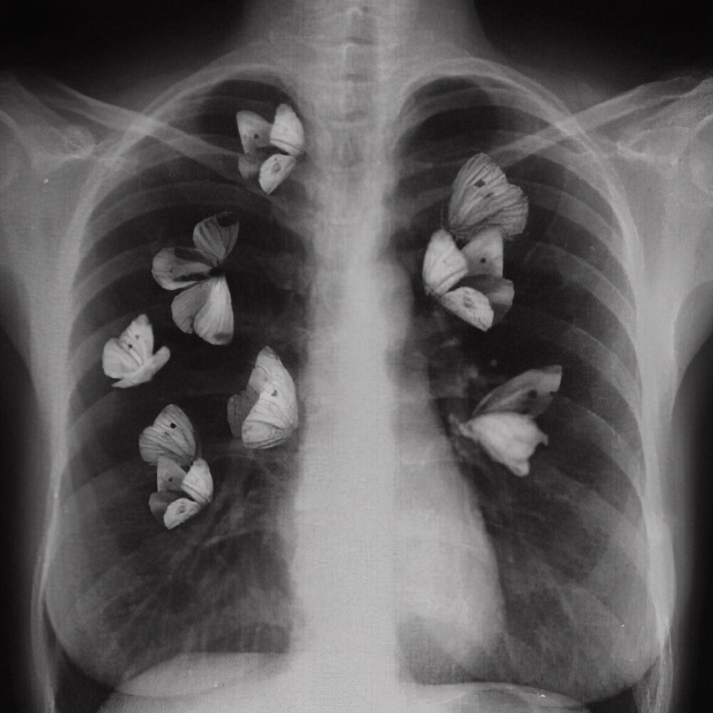 Бабочки в легких рентген