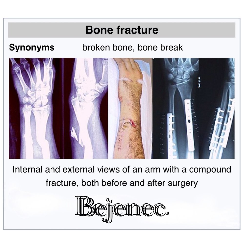 Break my leg hurt me bad. My Leg hurts. Bone synonyms. Four way Fracture песня персонажи.